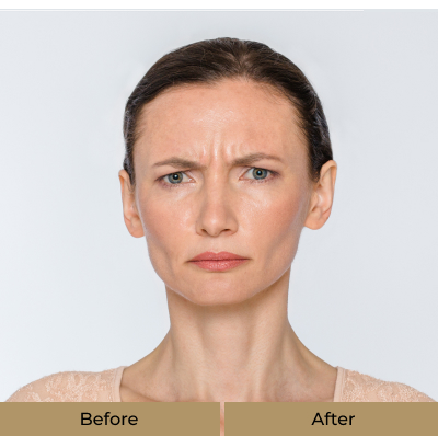 before-after-botox-a