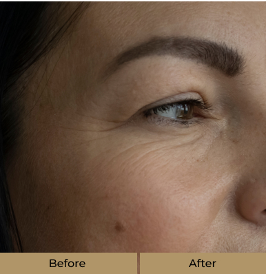 before-after-derma-fillers-a